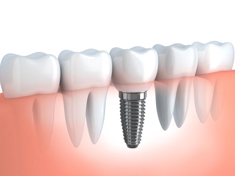 Dental Implants in Milford, MA