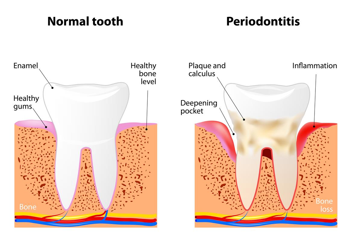 Periodontal in Milford, MA